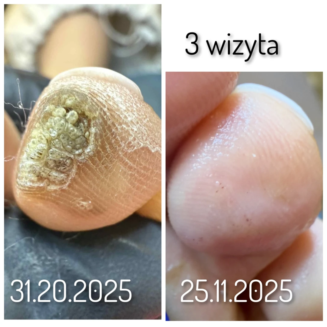 Brodawki wirusowe (kurzajki)