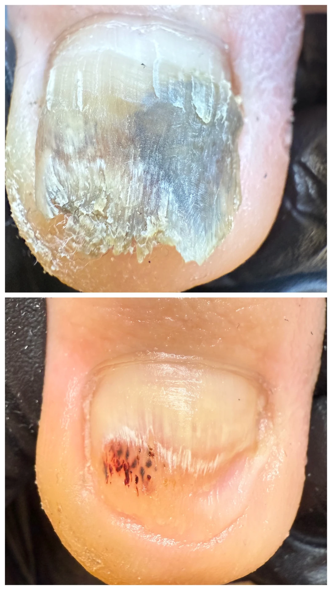 Krwiak podpaznokciowy