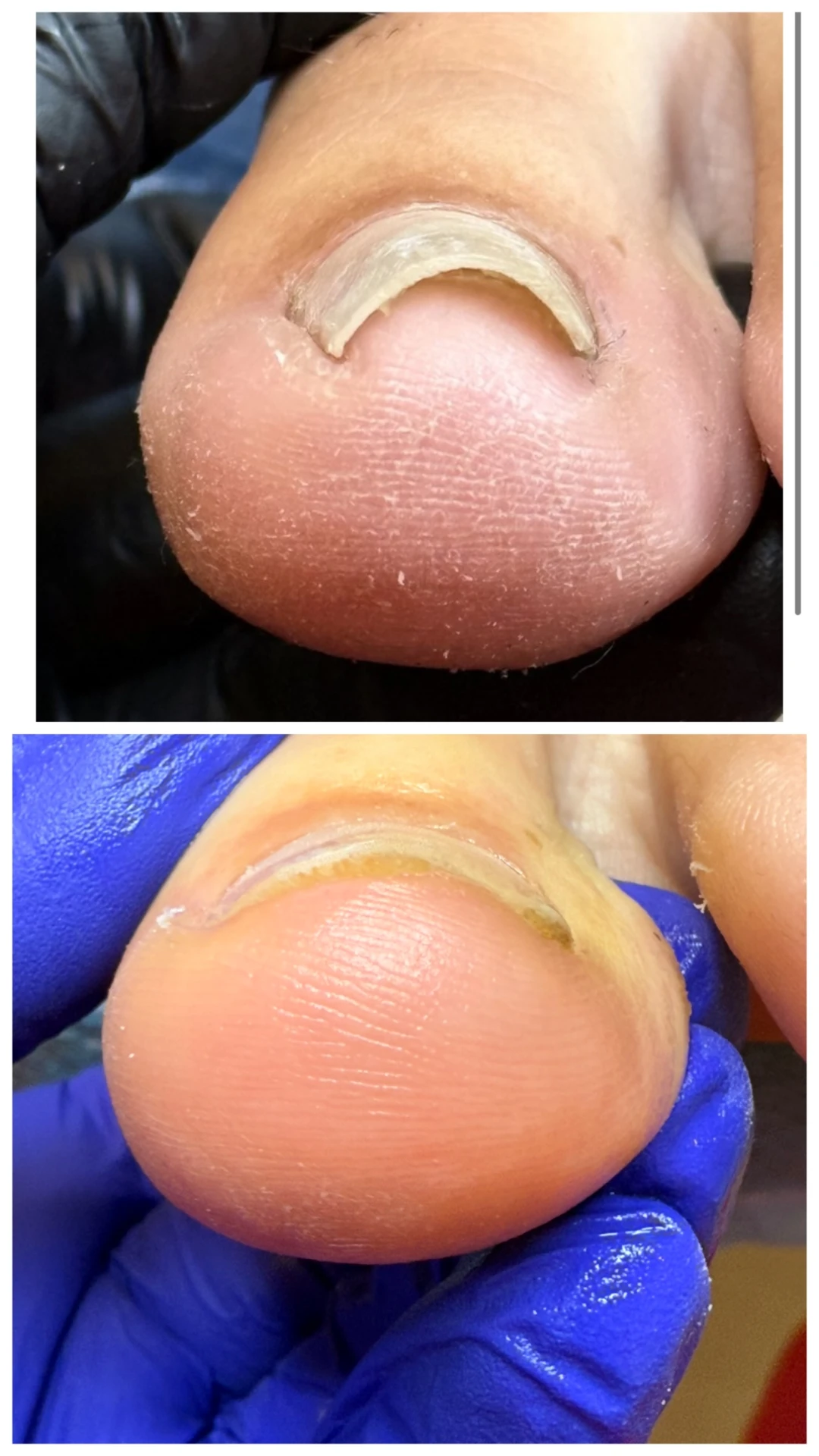 Wrastające paznokcie