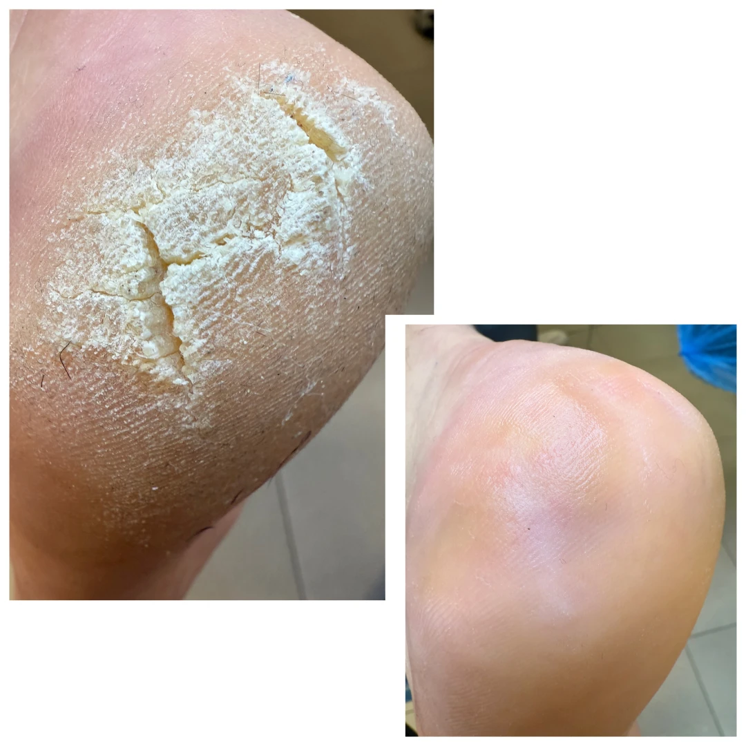 Sucha i pękająca skóra pięt