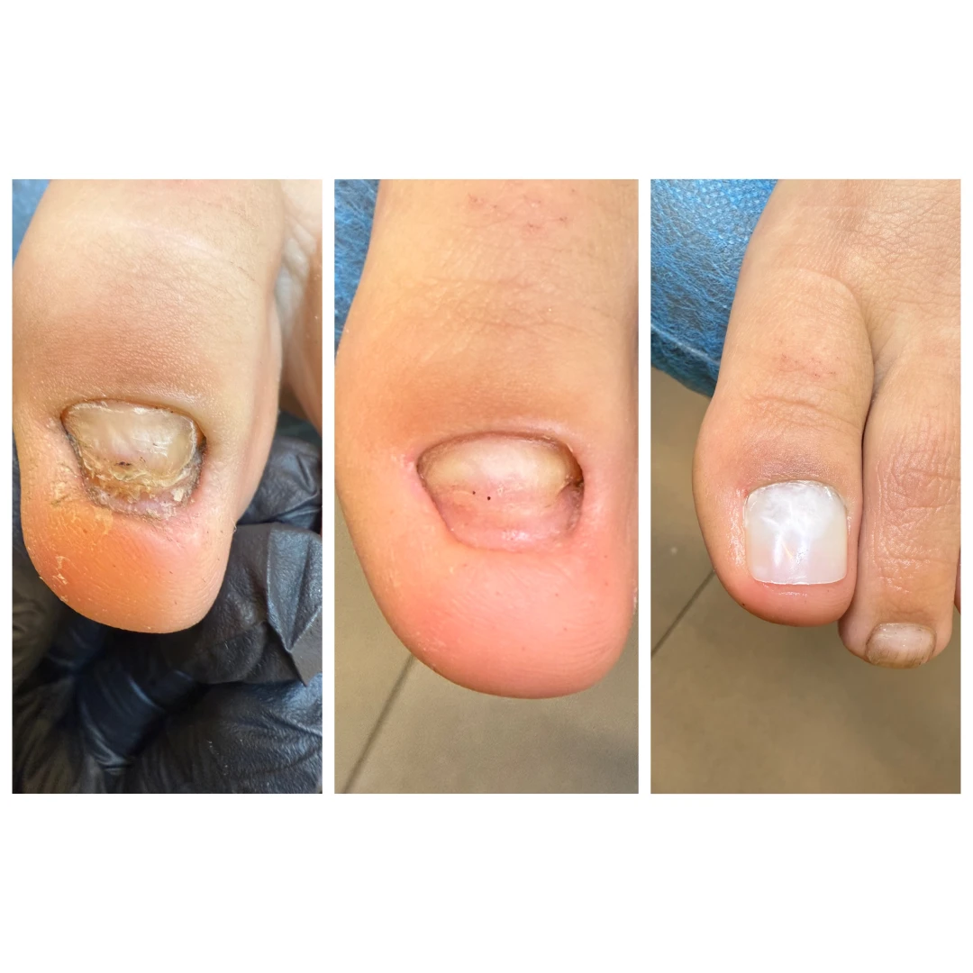 Rekonstrukcja paznokcia