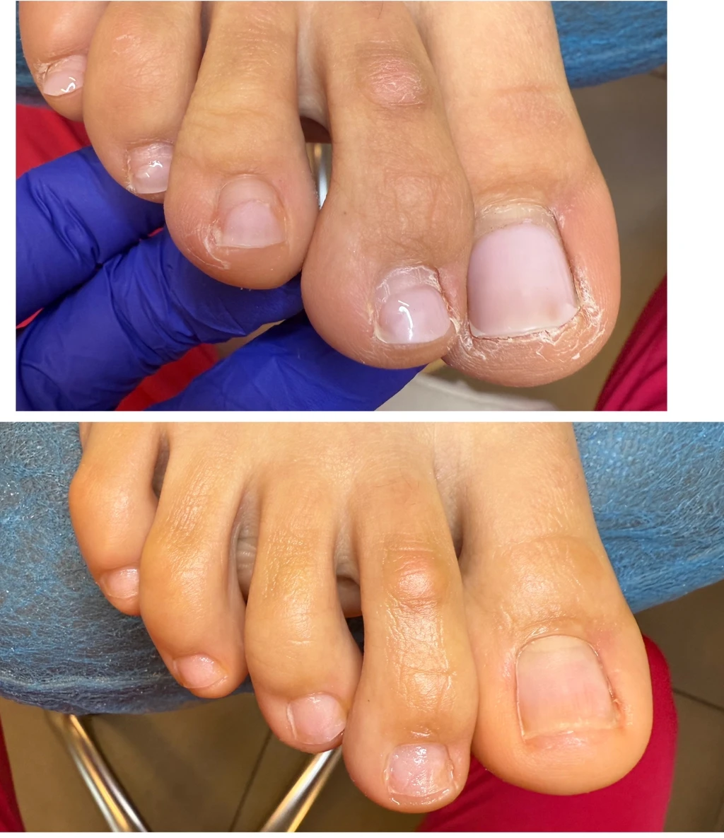 Podstawowy zabieg podologiczny